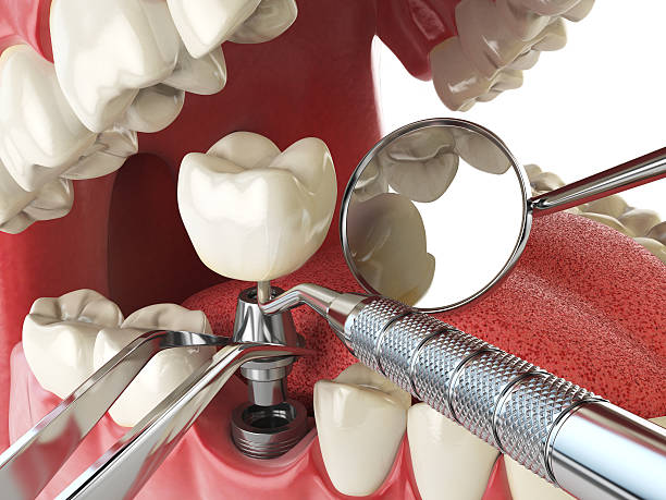 Best Emergency Dentist for Knocked-Out Tooth in Champion Heights, OH